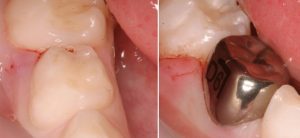stainless steel crown on deciduous tooth