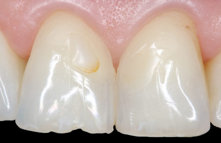 tooth repair