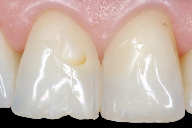 tooth repair